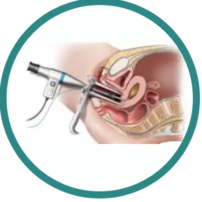 Ablação Endometrial