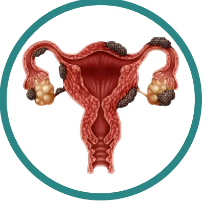 Cirurgia de Endometriose Profunda