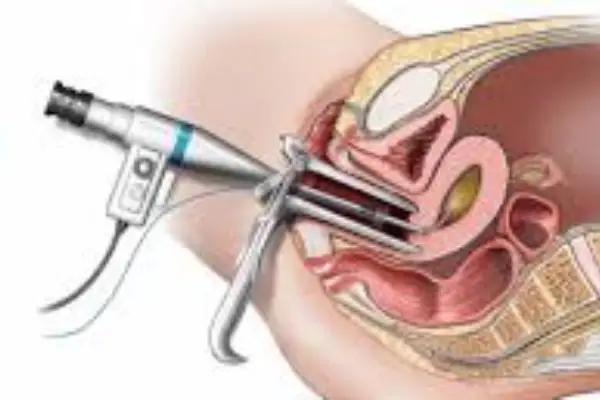 Dr. Rafael Alves - Ablação Endometrial em Recife, Caruaru e Palmares