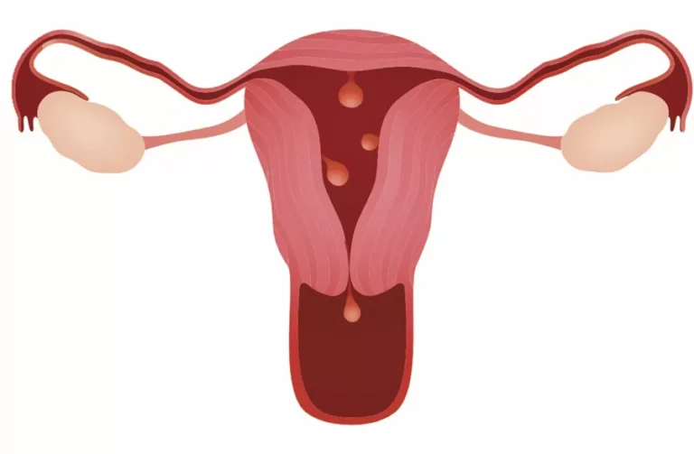 Dr. Rafael Alves - Remoção de Pólipos uterinos em Recife, Caruaru e Palmares
