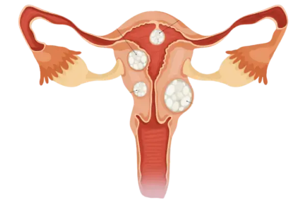 Dr. Rafael Alves - Tratamento para Miomas uterinos em Recife, Caruaru e Palmares