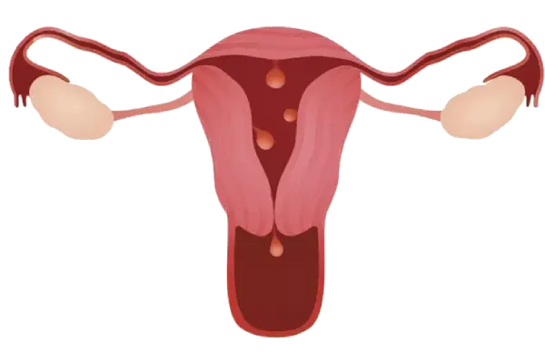 Dr. Rafael Alves - Tratamento para Pólipos uterinos em Recife, Caruaru e Palmares