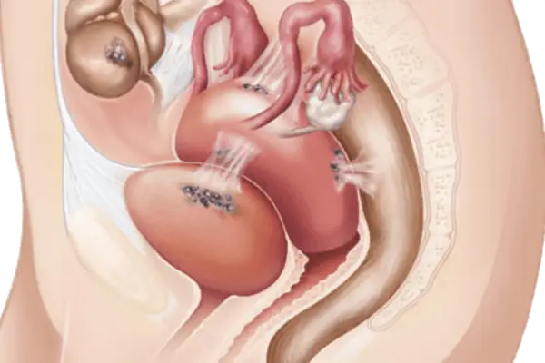 Tratamento de aderências pélvicas é a cirurgia para remoção de tecidos cicatriciais que causam dor pélvica ou infertilidade, restaurando a anatomia.