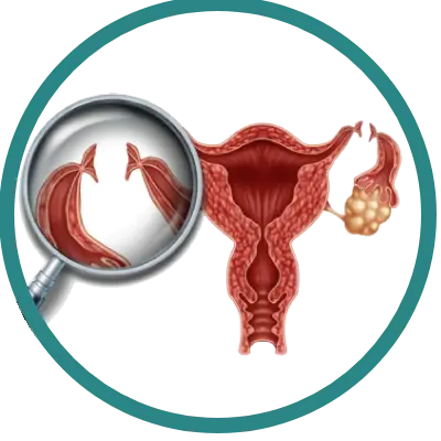Laqueadura Tubária (esterilização)