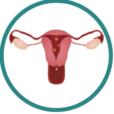 Remoção de Pólipos Uterinos