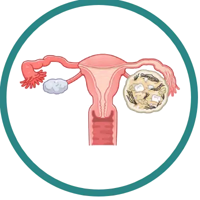 Retirada de Teratoma