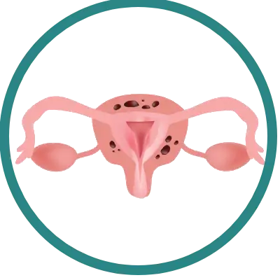 adenomiose
