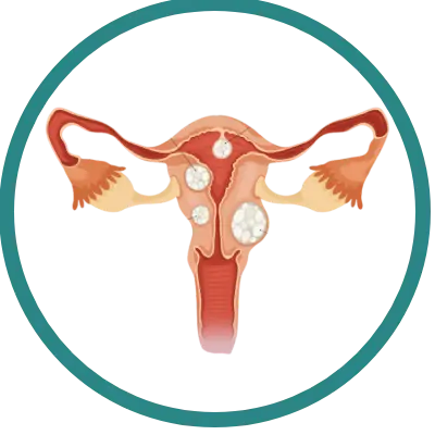 endometriose