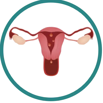 polipos uterinos