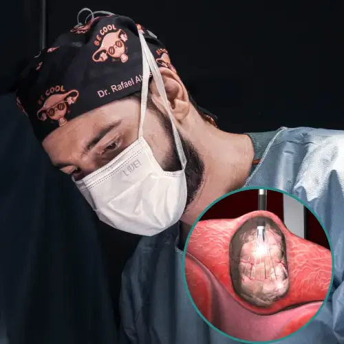 Dr. Rafael Alves - Ablação de miomas por radiofrequência em Recife, Caruaru e Palmares